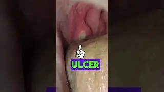 A white ulcer over tonsil: No antibiotic needed