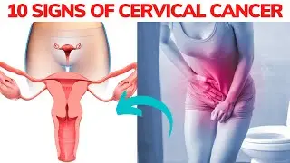 10 Signs of Cervical Cancer You Need to Know Early