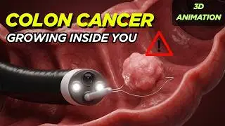 What happens during and after a colonoscopy? | 3D medical animation