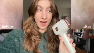 Innza IPL Laser Hair Removal System Review & Results