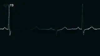 ECG plot with a QRS beep & HR