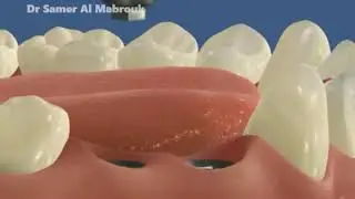 2 Lower Implants