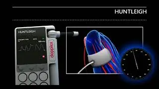 Toe Pressure Index (TBI) with Dopplex DMX