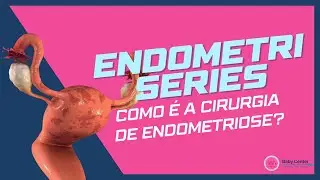 Como é a cirurgia de endometriose? - ENDOMETRISERIES (Episódio 7)