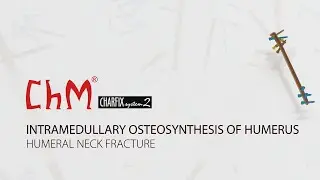 Intramedullary osteosynthesis of humerus with CHARFIX2 humeral nail - humeral neck fracture