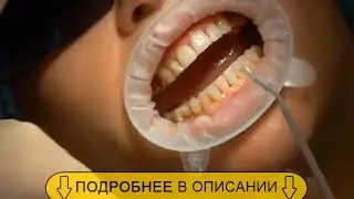 Бесплатная оздоровительная чuстка зубов от стоматолога!
