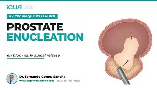 En Bloc HoLEP with Early Apical Release — My Technique Explained