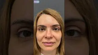 Эндоскопический лифтинг лба и висков