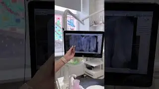 Лечение кисты