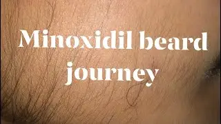 MONTH 11 & WEEK 3: BEARD JOURNEY | MY EXPERIENCES IN USING MINOXIDIL