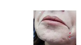 حقن البوتكس والديسبورت بأسفل الوجه والرقبه - جزء اول