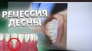 Рецессия десны из-за высокого прикрепления уздечки нижней губы