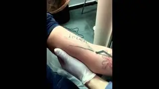 PLANET TATTOO LASER REMOVAL פלאנט טאטו הסרת קעקועים בלייזר