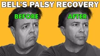 Bell's Palsy Recovery Timeline (4 days to 12 months)