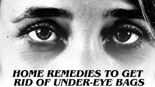 10 Easy Home Remedies To Get Rid Of Under Eye Bags