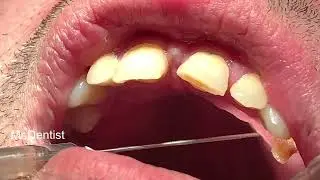 Extraction Of A Broken Tooth Using Local Anesthesia   !!!!