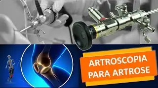 ARTROSCOPIA PARA ARTROSE NO JOELHO