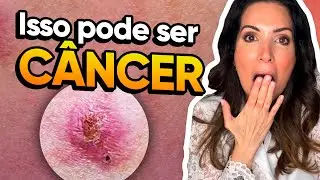Isso pode ser câncer de pele! #cancer de pele