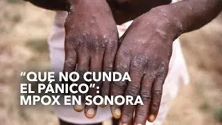 Casos de Mpox detectados en Sonora no son preocupación