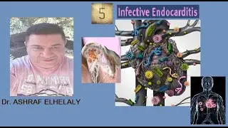 5-Bacteriology Infective endocarditis  حماقة السرنجاتى