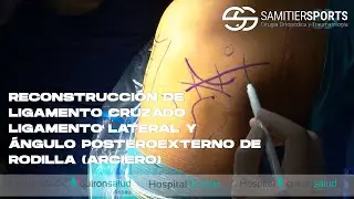 RECONSTRUCCION LIGAMENTO CRUZADO LIGAMENTO ANTERIOR, LIGAMENTO LATERAL Y TENDON POPLÍTEO (ARCIERO)