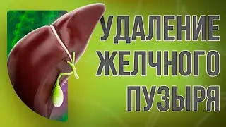 Gallbladder removal (cholecystectomy)