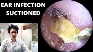 Pus and Dead Skin Suctioned From Ear Canal (Acute Otitis Externa)