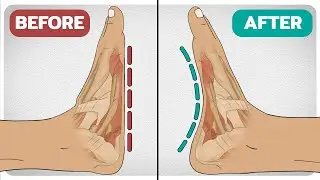 5 Exercises To Fix Flat-Feet (Fallen Arches)