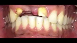 All-Ceramic Restorations