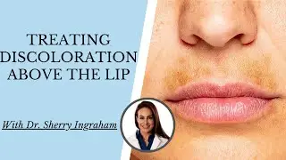 TREATING "SUNSTACHE" - UPPER LIP DISCOLORATION