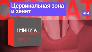 Препарируем цервикальную зону с учётом расположения зенита. 1 минута.