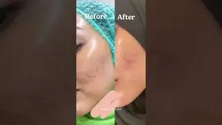Review ZAP YELLOW LASER | Melasma, Bekas Jerawat Kemerahan, Spider Vein, #skincare #zap #laser