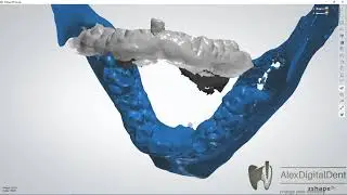 Creating an accurate model using СT and IOS/ Создание точной модели с использованием CT и IOS