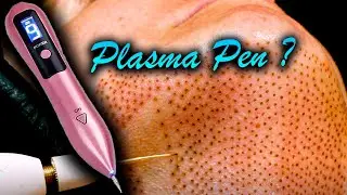 PLASMA PEN 🔥 REALMENTE FUNCIONA? verrugas, cicatrices de acné, arrugas en los parpados acrocordones