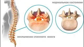 Miyelit kasalligi haqida | Миелит касаллиги ҳақида 