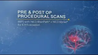 Pre & Post Op Procedural Scans of ICH Evacuations