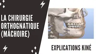 What is orthognathic facial surgery?