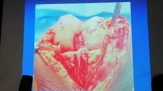 Valgus knee TKR