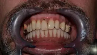 Restoration of dental implants within 24 hours. Papadent Clinic in Vilnius
