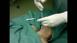 BACT technique