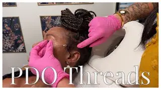 PDO Threads for nasolabial fold-  #faceLift #skin #antiAging #smileLines