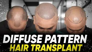 Hair Transplant in Nashik | Best Results & Cost of Hair Transplant in Nashik