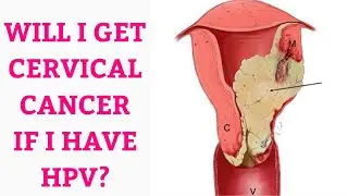 CERVICAL CANCER TREATMENT SYMPTOMS PREVENTION AND RISK FACTORS