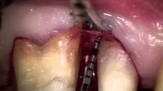 MIST (Periodontal Regeneration)