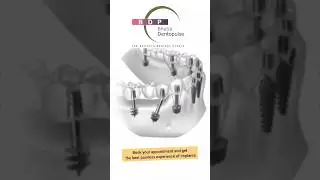 Get Teeth Implants and new Teeth in just 3 days! #implants #smilemakeover