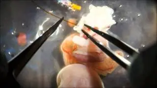 Cannulation of the uterine artery