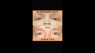 Blepharoplasty - Eyelid Surgery
