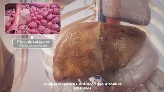 Doença Hepática Gordurosa não Alcoólica (Esteatose)