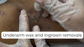Underarm wax, ingrown hair removal and blackhead removals 