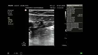 How to determine the cause of leg pain? Ultrasound of the arteries and veins of the lower extremi...